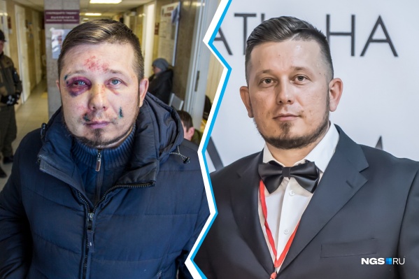 Андрею Радаеву досталось сильно: синяки и кровоподтеки не только на лице, но и на теле Андрею Радаеву досталось сильно: синяки и кровоподтеки не только на лице, но и на теле