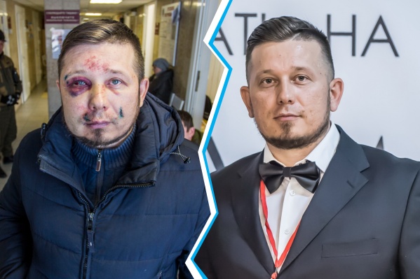 Андрею Радаеву досталось сильно: синяки и кровоподтеки не только на лице, но и на теле Андрею Радаеву досталось сильно: синяки и кровоподтеки не только на лице, но и на теле