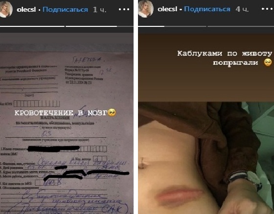 В сториз косметолог также разместила фото с раной на животе и с надписью «каблуками по животу попрыгали» В сториз косметолог также разместила фото с раной на животе и с надписью «каблуками по животу попрыгали»