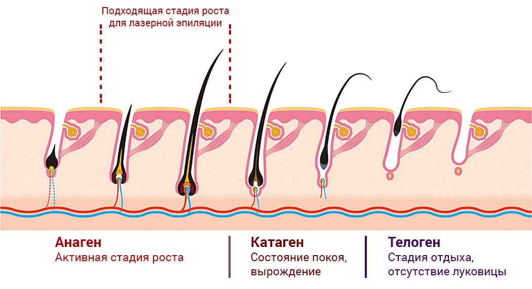 Разрушение волоса при лазерной эпиляции