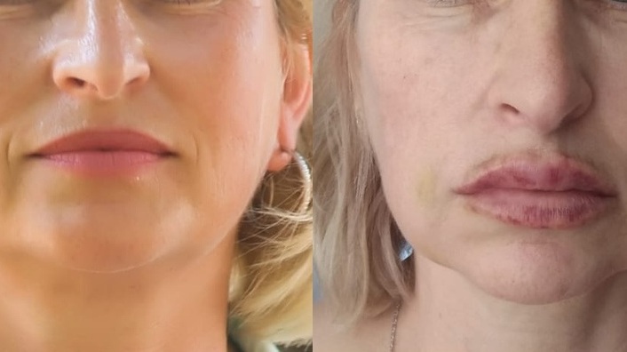 В декабре прошлого года женщина пришла на процедуры к косметологу. После этого у нее начались проблемы с губами и шишками на лице
