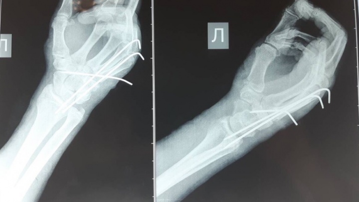 Пермские хирурги провели вторую за месяц операцию по приживлению руки