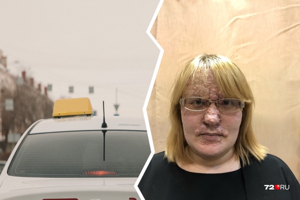 У девушки диагностировано одно из самых редких в мире генетических кожных заболеваний — синдром Брука-Шпиглера У девушки диагностировано одно из самых редких в мире генетических кожных заболеваний — синдром Брука-Шпиглера