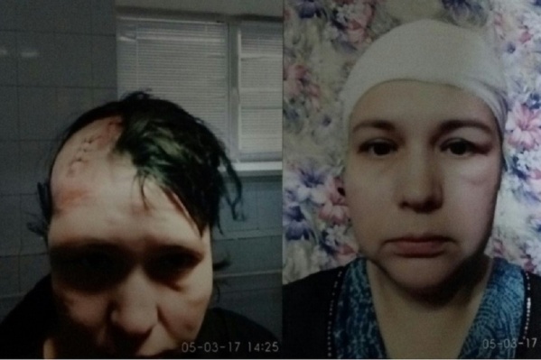 Шрам на голове Алины так и не зарос волосами и будет виден всю оставшуюся жизнь Шрам на голове Алины так и не зарос волосами и будет виден всю оставшуюся жизнь